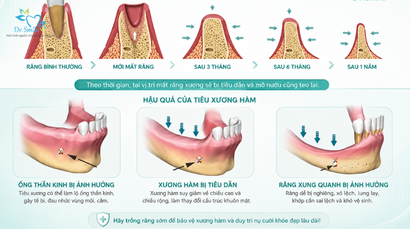 Ghép xương ổ răng điều trị tiêu xương