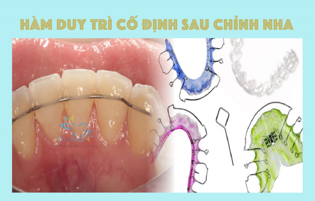 hàm duy trì sau chỉnh nha ham-duy-tri