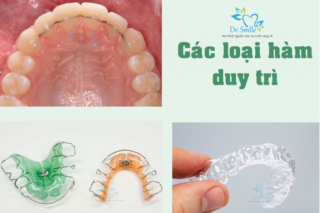 ham-duy-tri hàm duy trì chỉnh nha