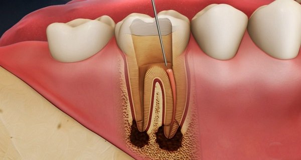 5. Các phương pháp thay thế và phục hình sau khi nhổ răng