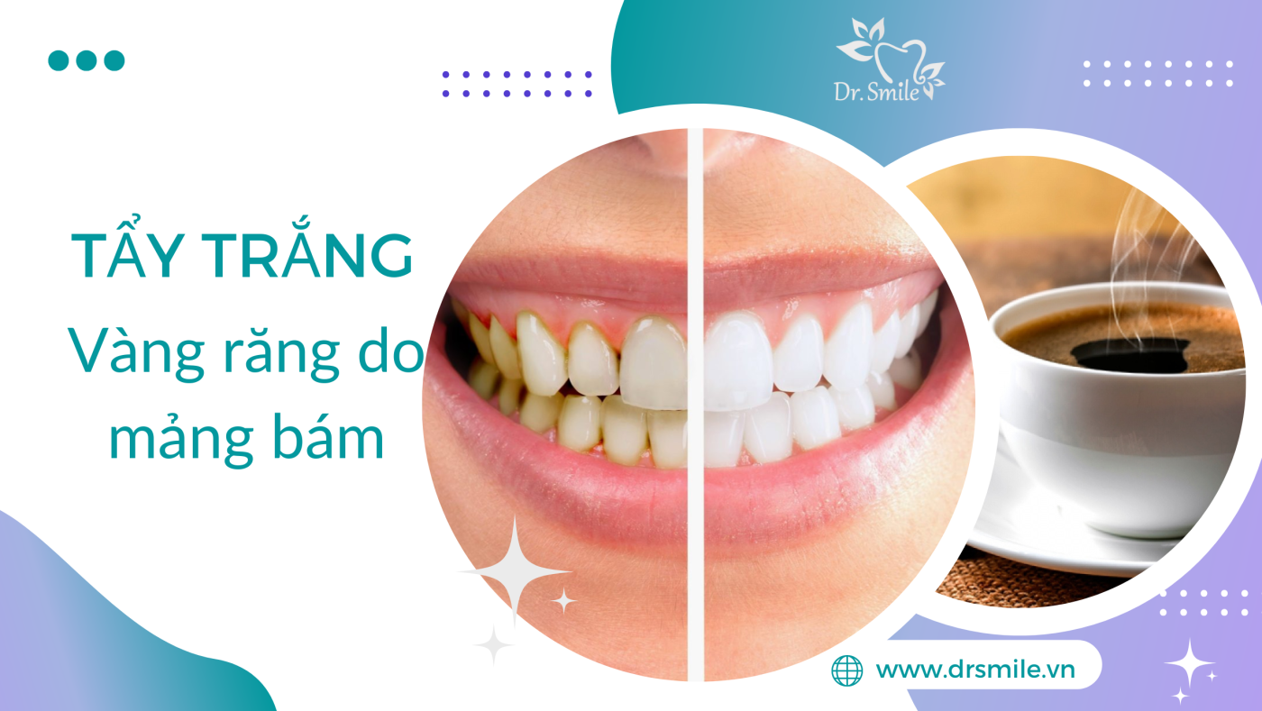 Những địa chỉ tẩy trắng răng ở Hà Nội được khách hàng đánh giá cao nhất là nơi nào?
