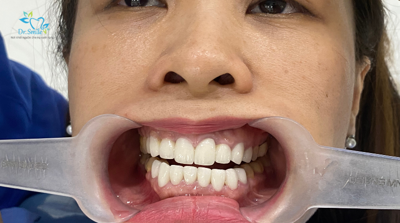 trong rang implant toan ham (11)