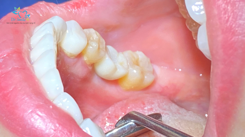 trong rang implant toan ham (12)