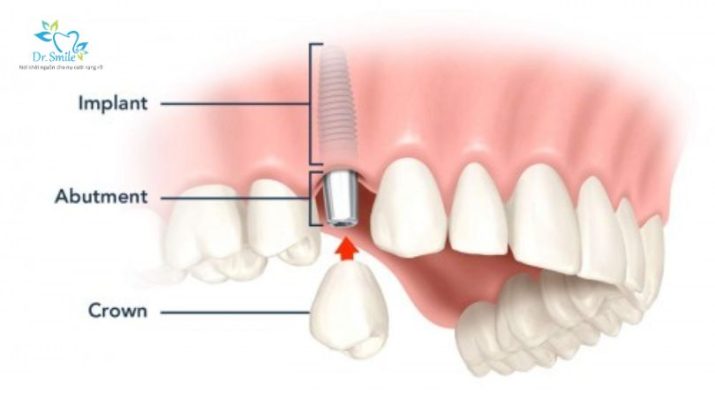 Implant của Đức