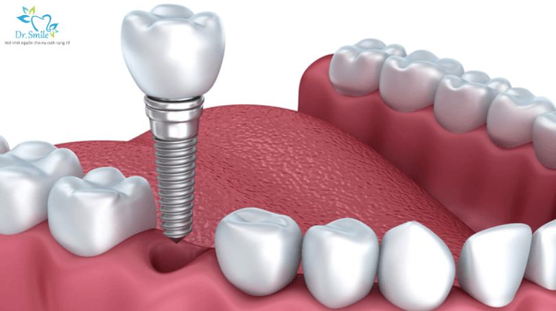 Điều kiện để trồng răng Implant