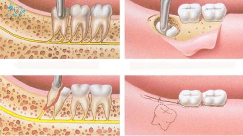 Đau Răng Số 7 Sau Khi Nhổ Răng Khôn: Nguyên Nhân và Cách Điều Trị Hiệu Quả