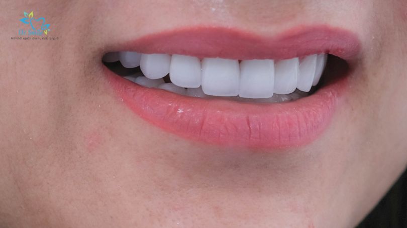 Tuổi thọ của răng sứ kim loại và Titan