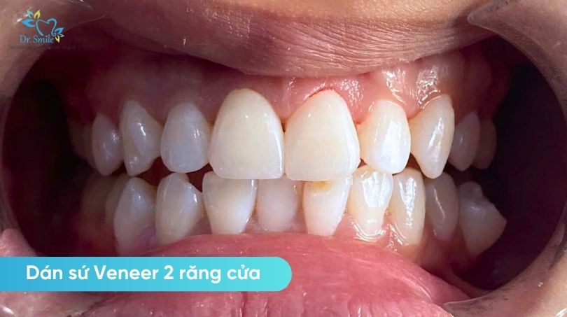 Veneer là một lớp sứ siêu mỏng