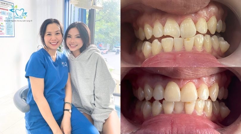 Kết quả dán sứ răng cửa mẻ tại Dr.Smile