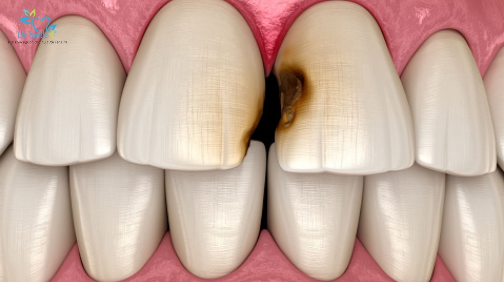 Sâu kẽ răng cửa thường diễn biến ở vị trí tiếp xúc giữa hai răng
