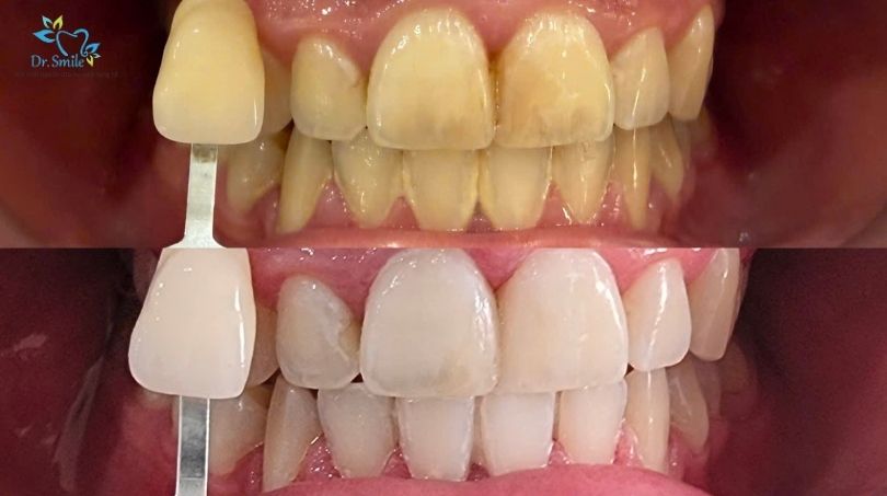 Tẩy trắng răng nhanh không mang lại hiệu quả vĩnh viễn