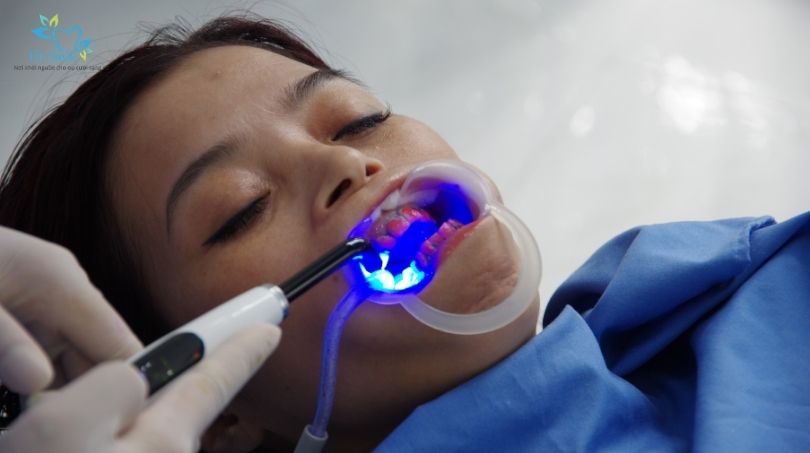 Tẩy trắng răng nhanh có thể gây ê buốt nhẹ