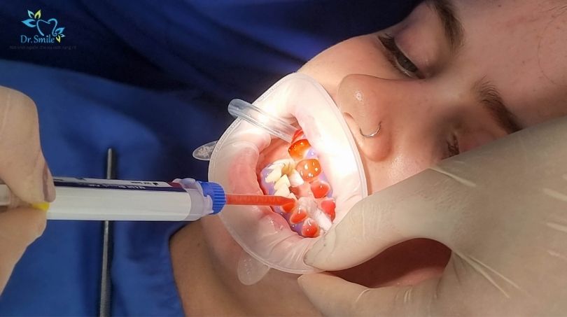 Tẩy trắng răng nhanh mất khoảng 45-60 phút