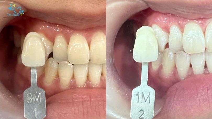 Chọn địa chỉ tẩy trắng răng nhanh tại Hà Nội 