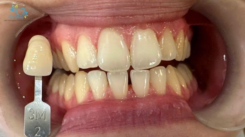 Răng ố vàng khiến bạn kém tự tin