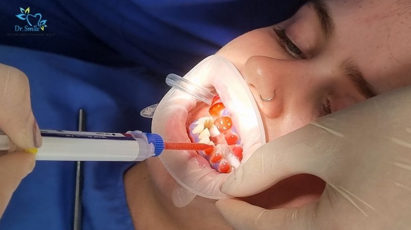 Tẩy trắng răng tại phòng khám