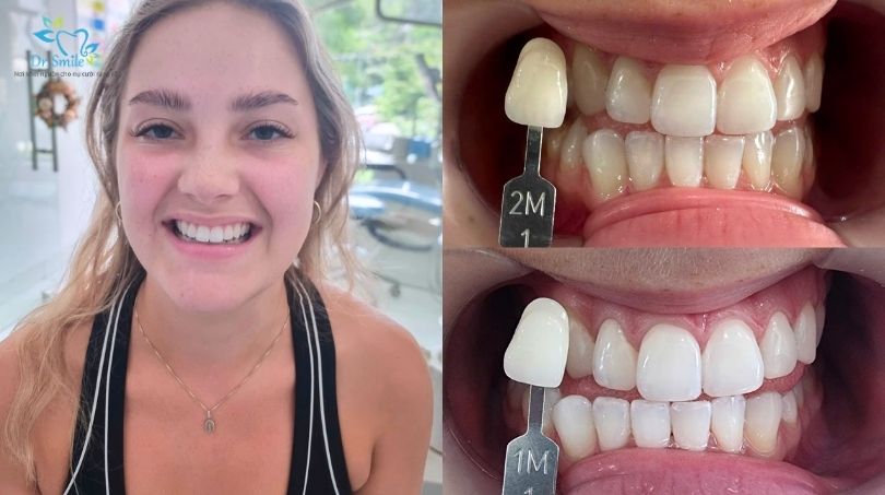 Tẩy trắng răng giá bao nhiêu Hà Nội?