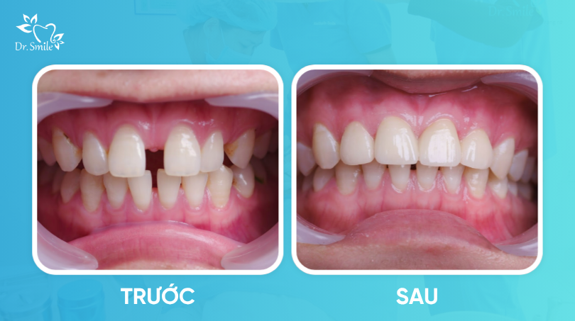 Hình ảnh trước và sau khi bọc sứ cho răng thưa nhẹ tại Dr.Smile