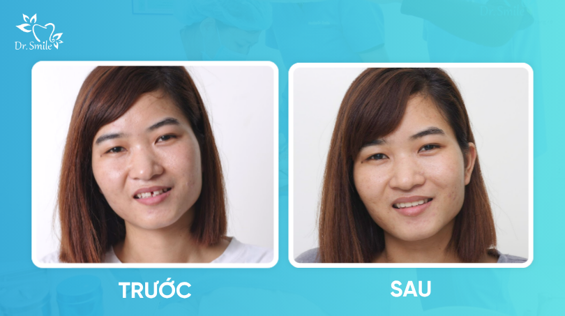 Khách hàng lấy lại tự tin sau khi làm sứ cho răng thưa nhẹ 