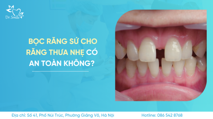 Bọc răng sứ cho răng thưa nhẹ