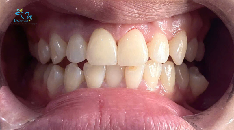 Răng không đều có làm răng sứ được không