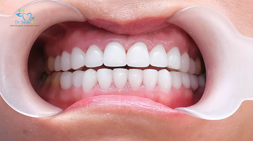 Răng không đều có làm răng sứ được không