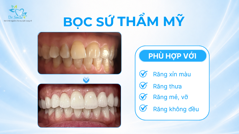 Bọc sứ thẩm mỹ