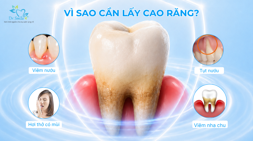 Vì sao cần lấy cao răng?