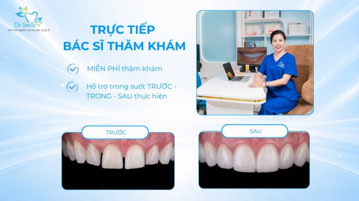 Dán sứ Veneer siêu mỏng chuẩn thẩm mỹ tại Nha khoa Dr.Smile