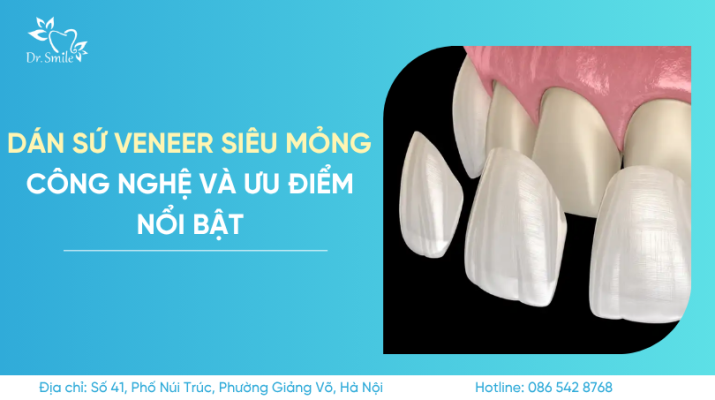 dán sứ veneer siêu mỏng