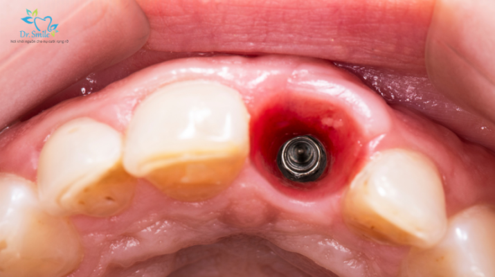 Làm sao để Implant sử dụng được lâu dài nhất?