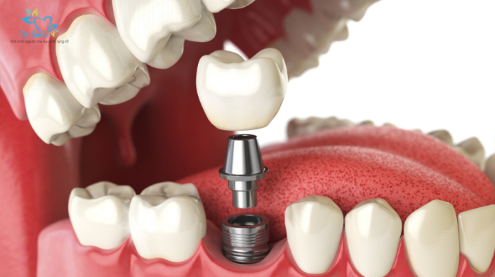 Tuổi thọ trung bình của trụ Implant là bao lâu?