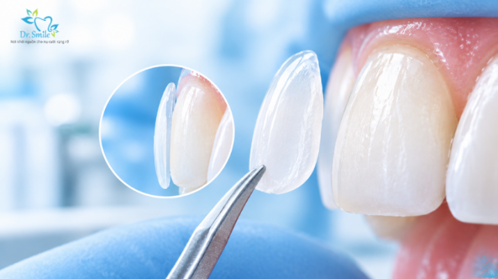 Các bước trong kỹ thuật dán sứ Veneer chuẩn y khoa