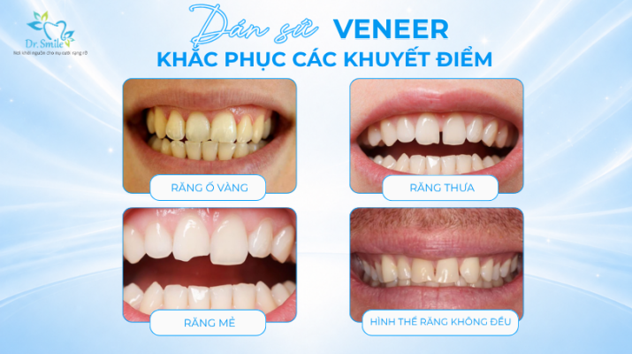Kỹ thuật dán sứ veneer khắc phục các nhược điểm