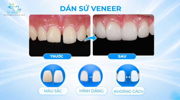 Dán sứ Veneer