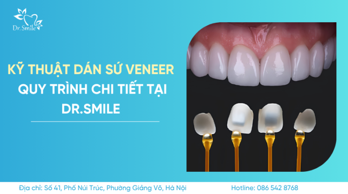 kỹ thuật dán sứ veneer