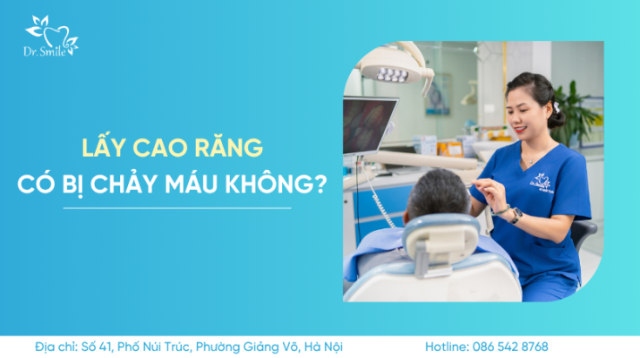 lấy cao răng có bị chảy máu không