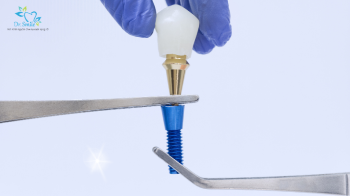 Nguồn gốc trụ Implant rõ ràng, chính hãng