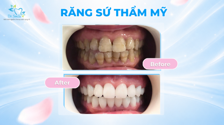 Răng toàn sứ